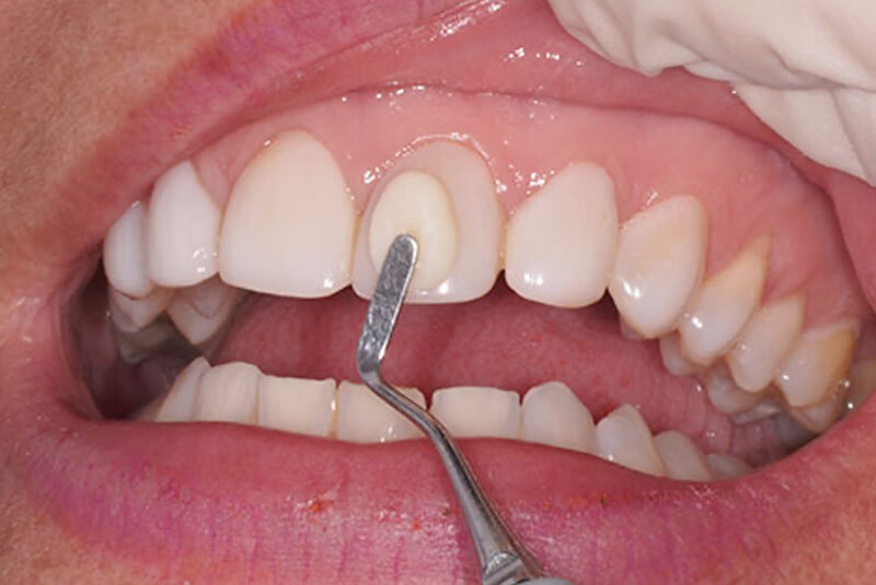 Carillas dentales: Ventajas y desventajas